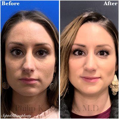 Facial Plastic Surgery Alpharetta .